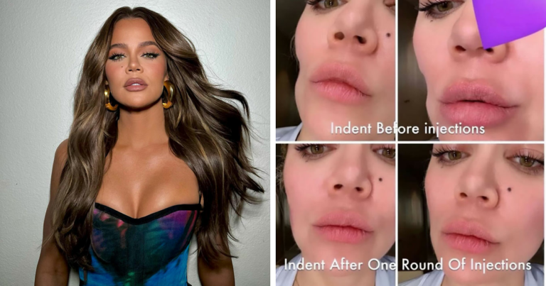 Khloé Kardashian Shares Before-and-After Pics of Facial Injections After Removing Tumor From Cheek